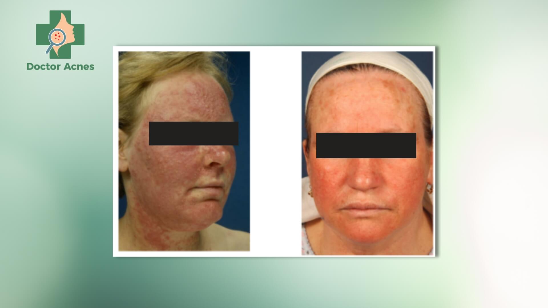 Tình trạng da đỏ thường phát triển từ vùng da còn vết chàm cũ và lan rộng ra từng ngày - Doctor Acnes
