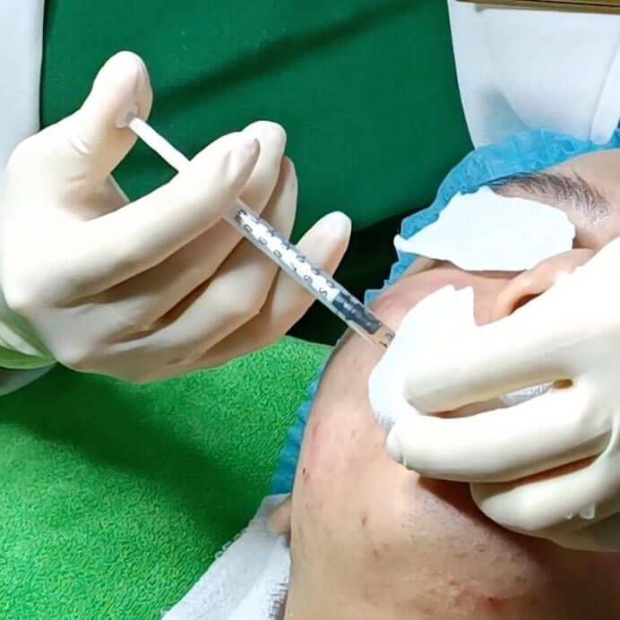 Phương pháp tiêm mesotherapy