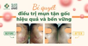 bí quyết điều trị mụn tận gốc hiệu quả và bền vững