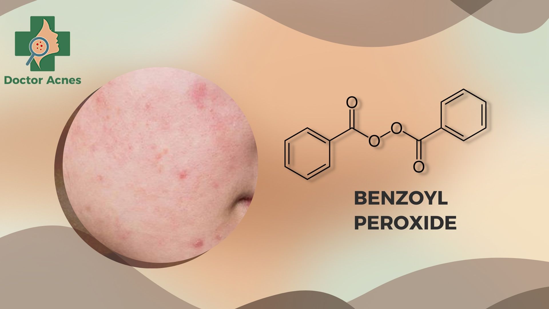 Benzoyl peroxide (BPO) - Doctor Acnes