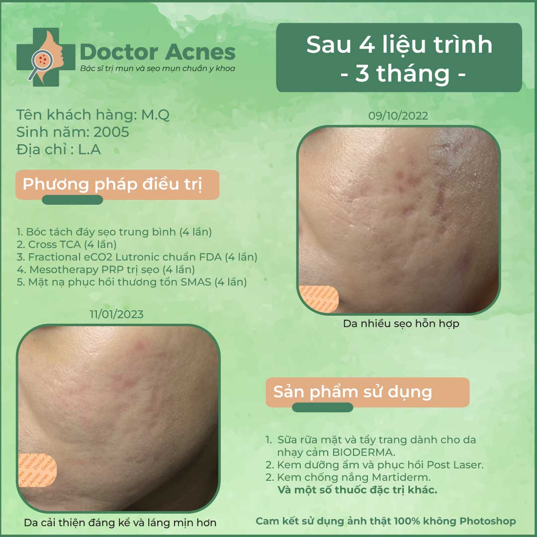 Ca lâm sàng khách hàng Minh Quân điều trị sẹo tại Phòng khám Doctor Acnes - Doctor Acnes