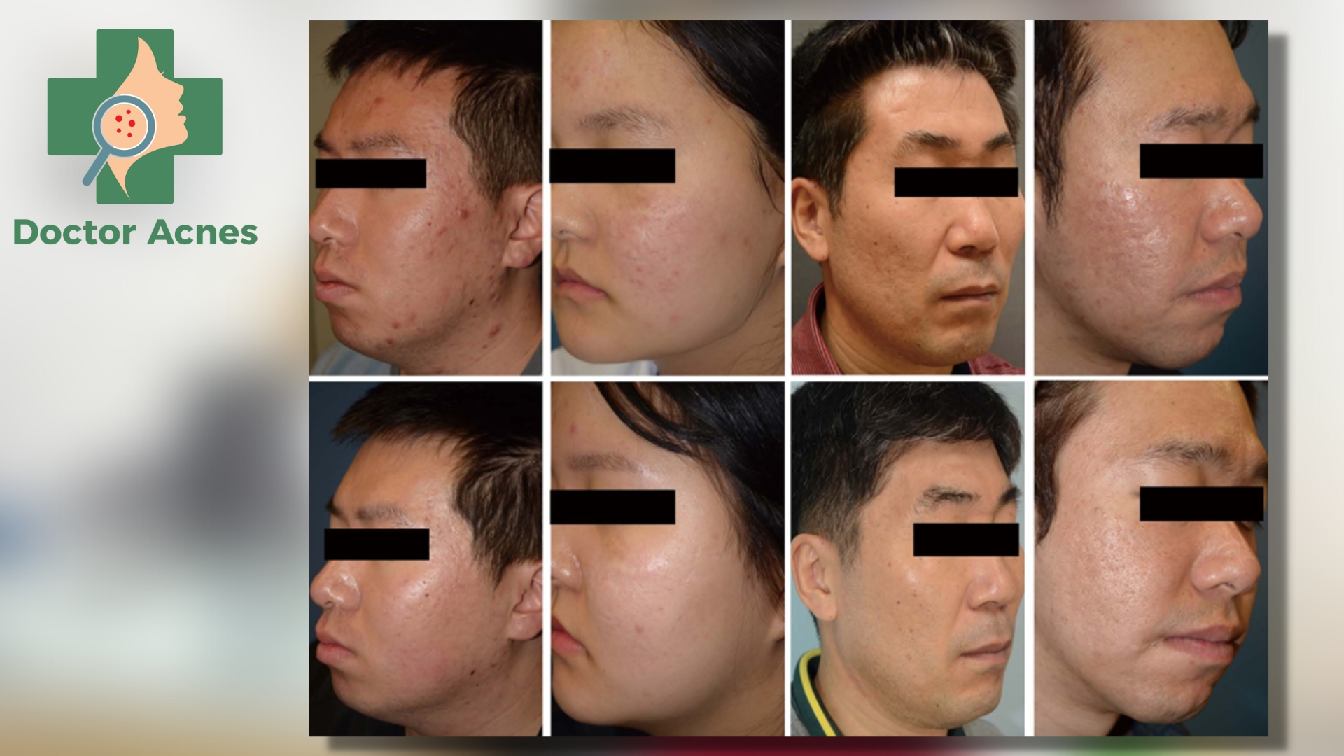 Hình ảnh trước và sau điều trị 3 tháng của 4 người tham gia nghiên cứu - Doctor Acnes