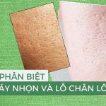 Hướng dẫn cách phân biệt lỗ chân lông to và sẹo đáy nhọn