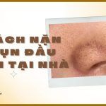 Cách nặn mụn đầu đen tại nhà an toàn và hiệu quả