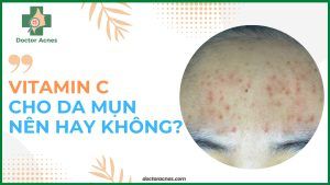 Thumb Có nên sử dụng vitamin C cho da mụn hay không - Doctor Acnes