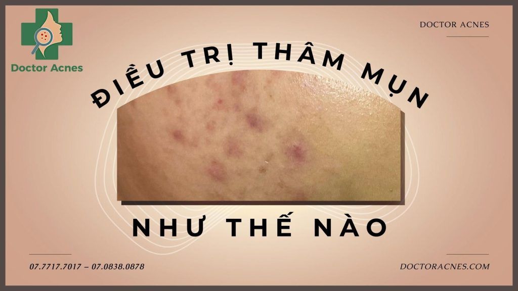 Thumb Điều trị thâm mụn như thế nào - Doctor Acnes