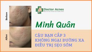 Thumb Minh Quân – Bạn học sinh cấp ba không ngại đường xa để trị sẹo sớm - Doctor Acnes