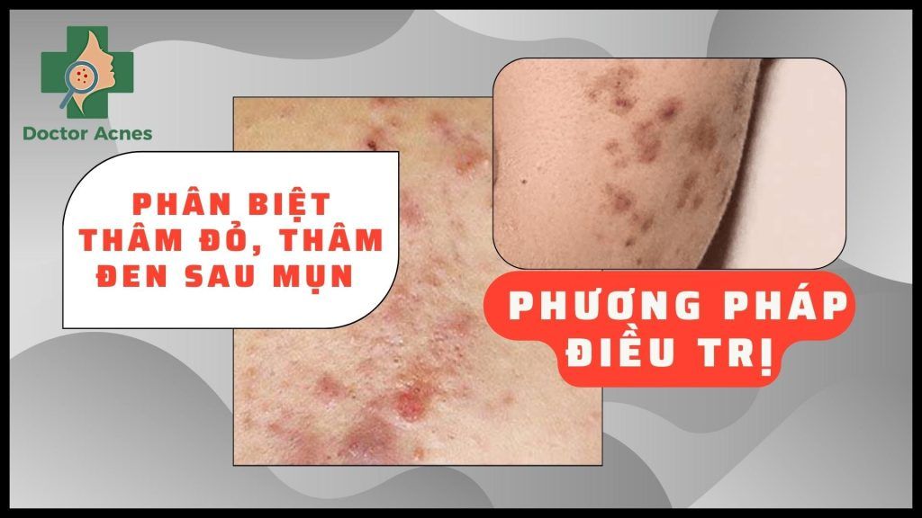 Phân biệt thâm đỏ, thâm đen sau mụn và phương pháp điều trị - Doctor Acnes