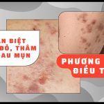 Phân biệt thâm đỏ và thâm đen sau mụn: phương pháp điều trị