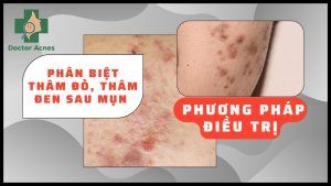 Phân biệt thâm đỏ, thâm đen sau mụn và phương pháp điều trị - Doctor Acnes