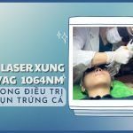 Vai trò của laser xung dài Nd:YAG 1064 nm trong điều trị mụn trứng cá