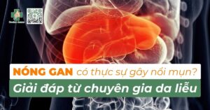 nóng gan có thật sự gây nổi mụn