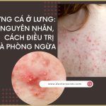 Mụn trứng cá ở lưng: nguyên nhân, cách điều trị và phòng ngừa