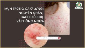 Mụn trứng cá ở lưng nguyên nhân, cách điều trị và phòng ngừa