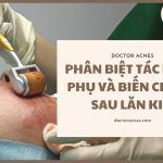 Phân biệt tác dụng phụ và biến chứng sau lăn kim