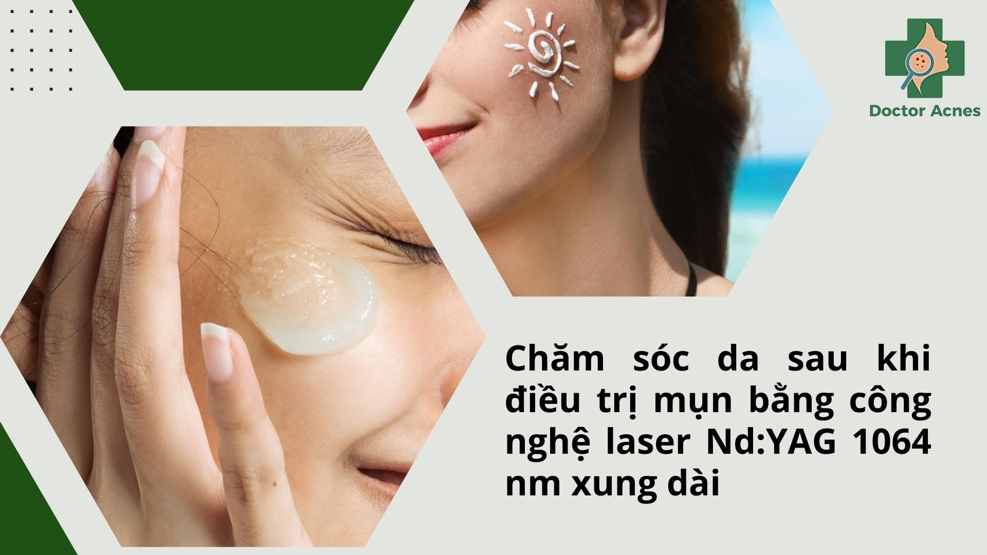 chăm sóc da sau điều trị mụn bằng công nghệ laser Nd:YAG 1064 nm xung dài