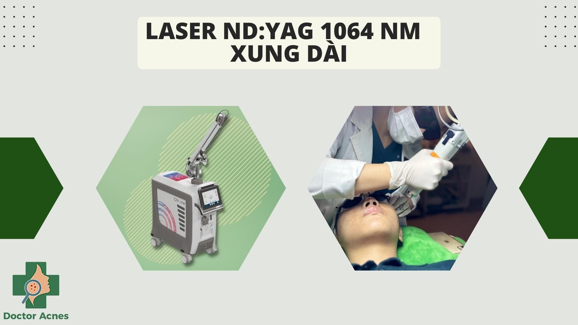 công nghệ laser Nd:YAG 1064 nm xung dài