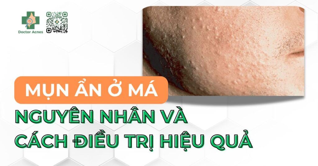 mụn ẩn ở má