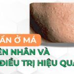 Mụn ẩn ở má: nguyên nhân và cách điều trị hiệu quả