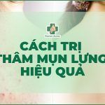 Cách trị thâm mụn lưng hiệu quả chuẩn y khoa từ Bác sĩ Da liễu