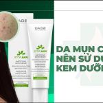 Da mụn có nên dùng kem dưỡng ẩm không?