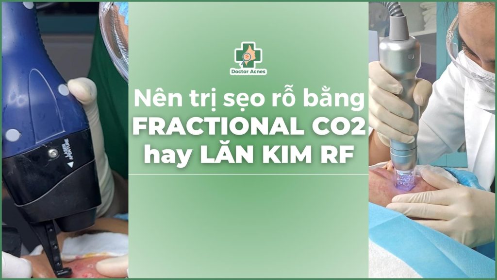 trị sẹo rỗ bằng lăn kim hay laser