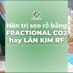 Nên trị sẹo rỗ bằng laser fractional CO2 hay lăn kim RF