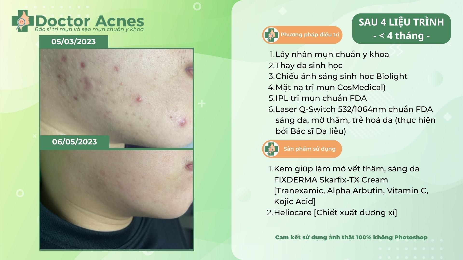 ca lâm sàn trị mụn nội tiết thành công tại doctor acnes