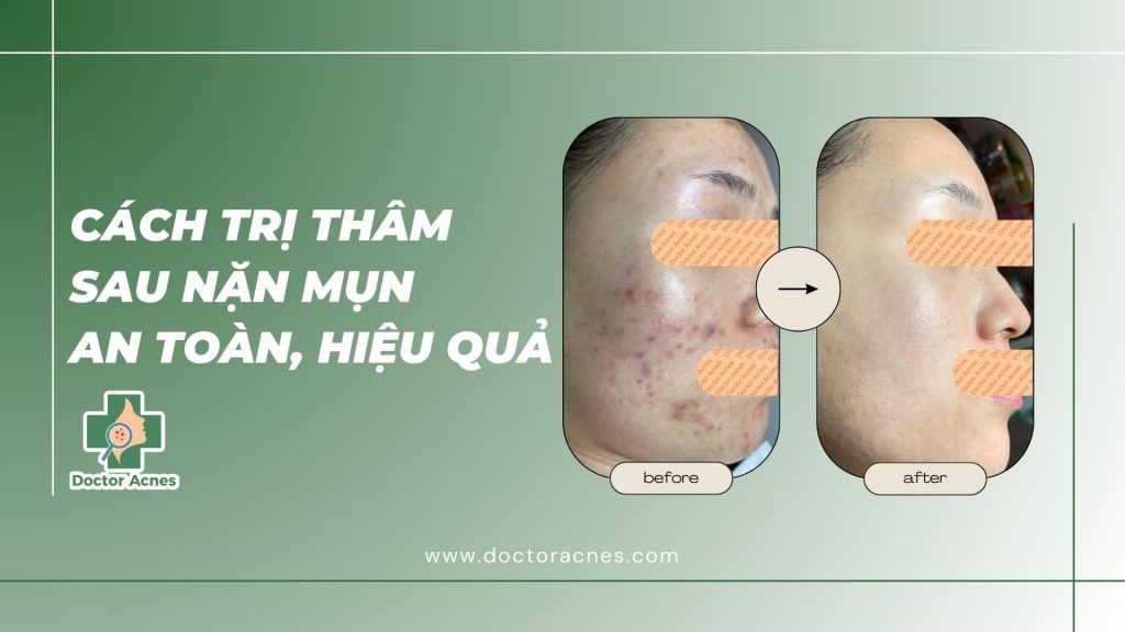 Cách điều trị thâm sau nặn mụn