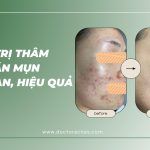 Cách trị thâm sau khi nặn mụn an toàn, hiệu quả