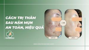 Cách điều trị thâm sau nặn mụn