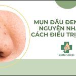 Mụn đầu đen ở mũi: nguyên nhân và cách điều trị tại nhà