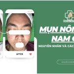 Nguyên nhân và cách điều trị mụn nội tiết ở nam giới hiệu quả