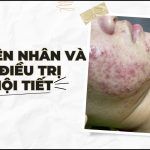 Nguyên nhân và cách điều trị mụn nội tiết