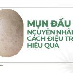 Mụn đầu đen: nguyên nhân và cách điều trị hiệu quả