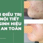 Cách trị mụn nội tiết sau sinh hiệu quả, an toàn