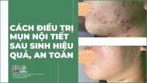 Cách trị mụn nội tiết sau sinh hiệu quả, an toàn