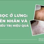 Mụn bọc ở lưng: nguyên nhân và cách điều trị hiệu quả