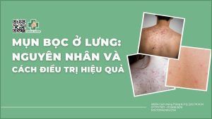 Mụn bọc ở lưng nguyên nhân và cách điều trị hiệu quả