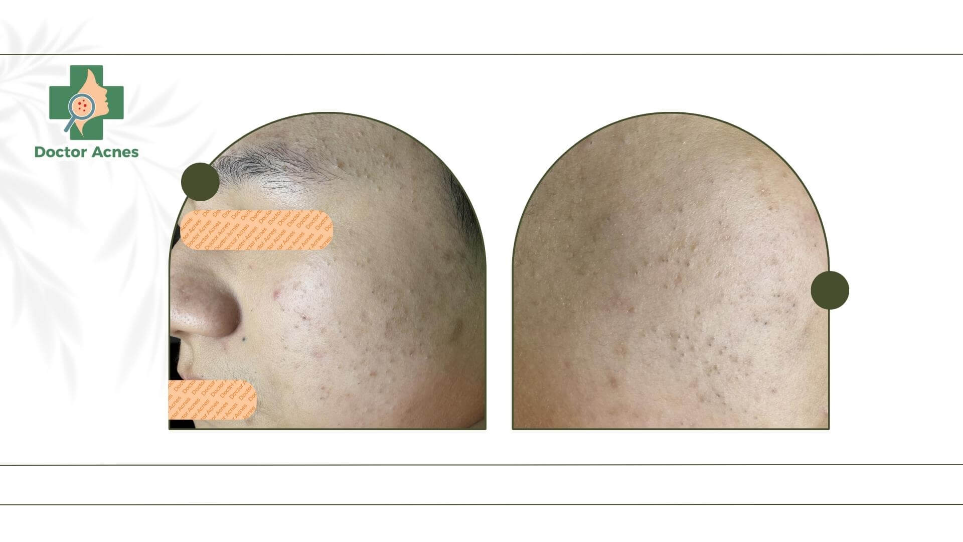Mụn đầu đen thường phổ biến ở người có da dầu hoặc da hỗn hợp