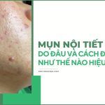 Lý do bị mụn nội tiết ở nữ và cách điều trị hiệu quả