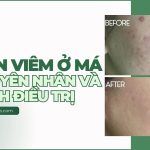 Mụn viêm ở má: nguyên nhân và cách điều trị