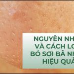 Nguyên nhân và cách loại bỏ sợi bã nhờn hiệu quả