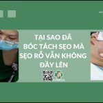 Tại sao đã bóc tách sẹo mà sẹo rỗ vẫn không đầy lên