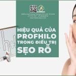 Hiệu quả của Profhilo® trong điều trị sẹo rỗ