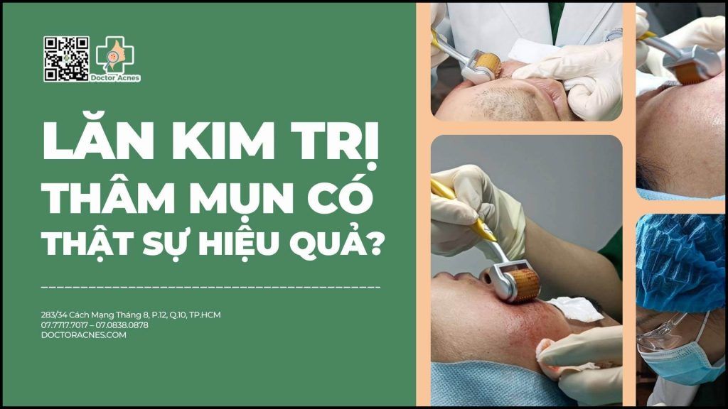 lăn kim trị thâm mụn có thật sự hiệu quả