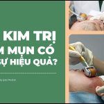 Lăn kim trị thâm mụn bao lâu thì khỏi?