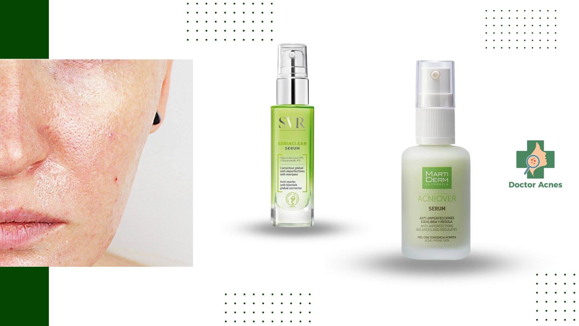 serum chứa salicylic acid, niacinamide và kẽm giúp giảm bài tiết bã nhờn, thu hẹp lỗ chân lông và cải thiện bề mặt da