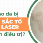 Vì sao da bị tăng sắc tố sau laser và cách điều trị hiệu quả?