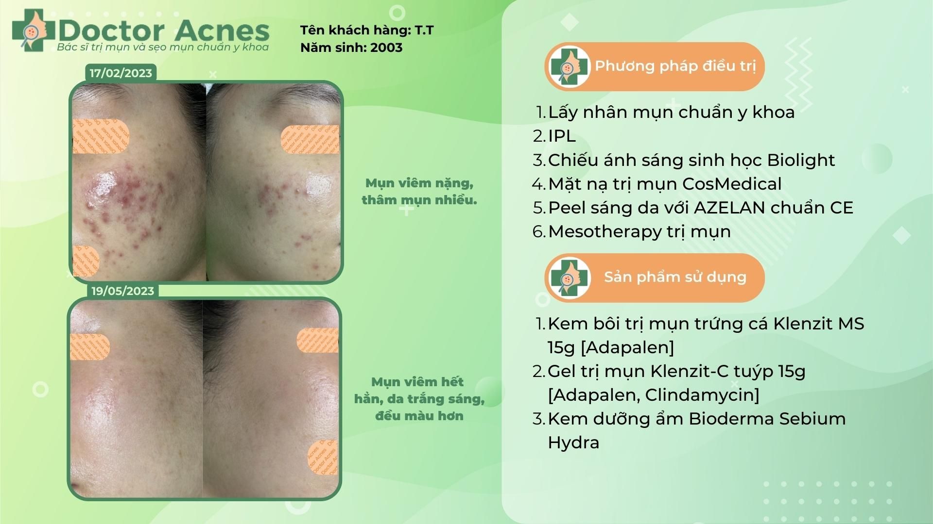 ca lâm sàng điều trị mụn thành công tại doctor acnes